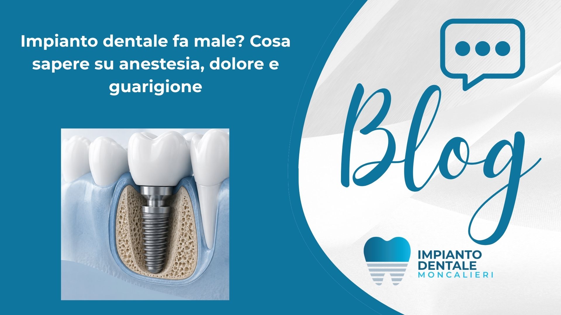 IMPIANTO DENTALE