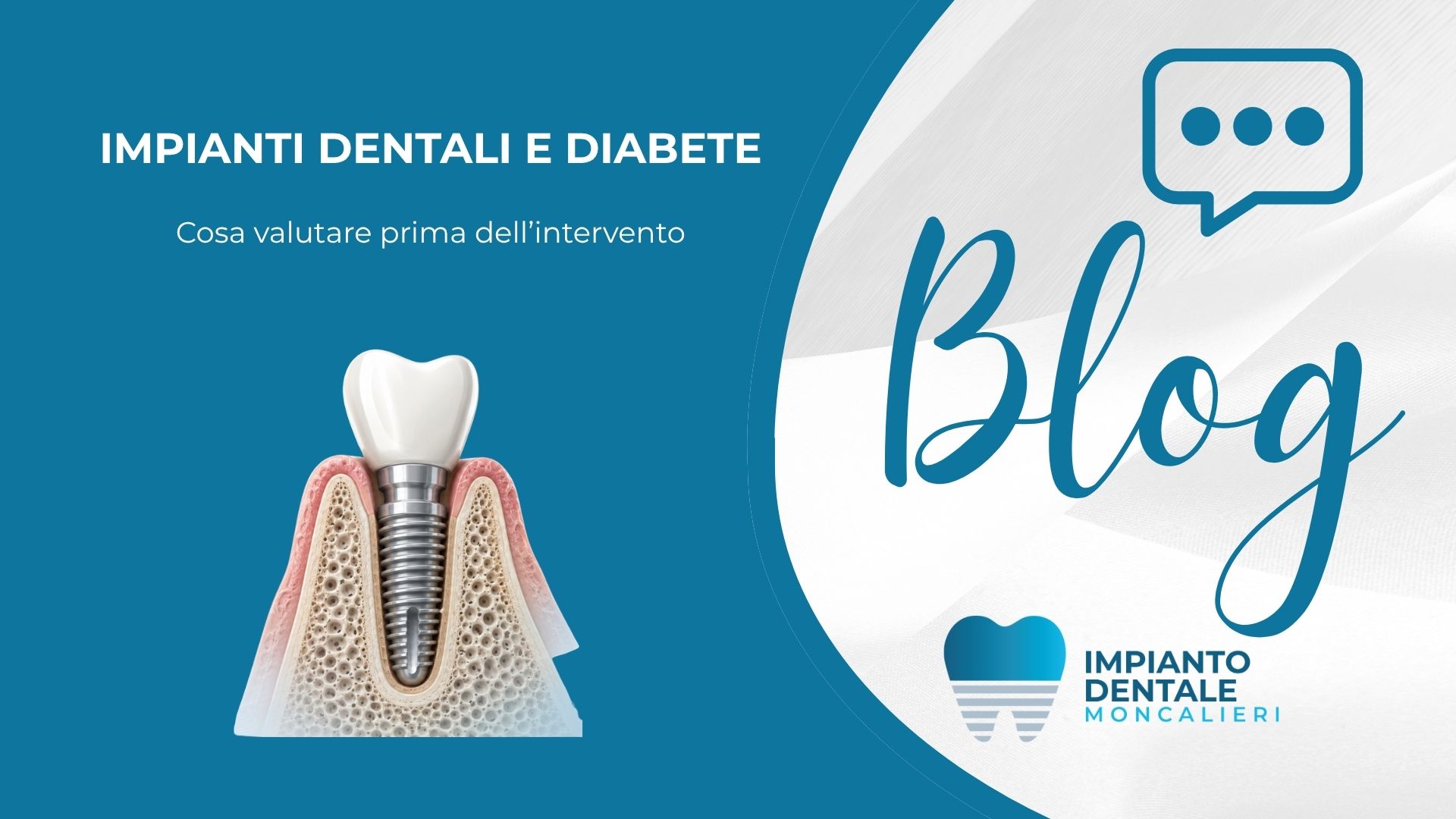 IMPIANTO DENTALE